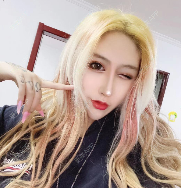 更美 - 更美用户KIeTphRcct的经验 | 自体脂肪面部填充 | 北京 | 自体脂肪丰苹果肌 | 自体脂肪丰太阳穴