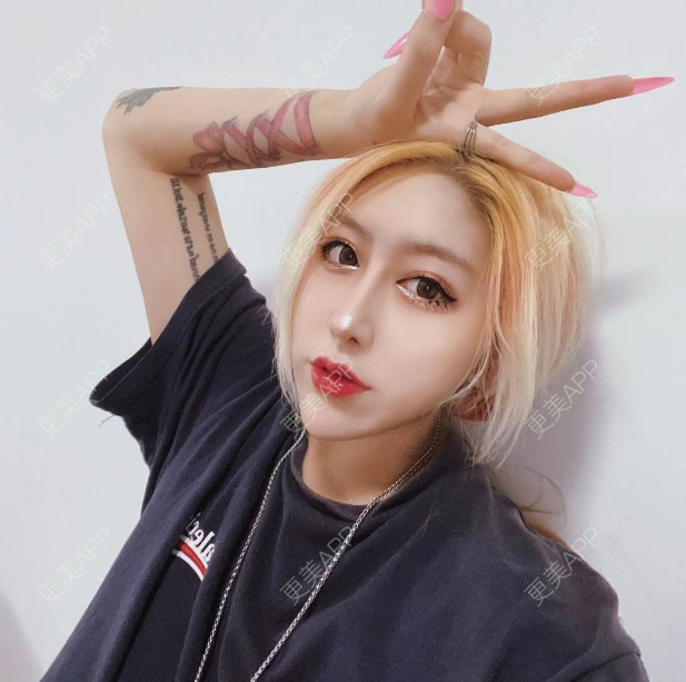 更美 - 更美用户KIeTphRcct的经验 | 自体脂肪面部填充 | 北京 | 自体脂肪丰苹果肌 | 自体脂肪丰太阳穴