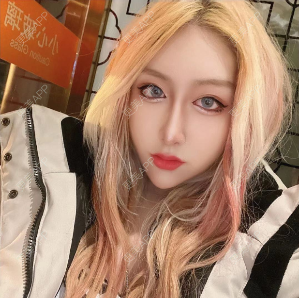 更美 - 更美用户KIeTphRcct的经验 | 自体脂肪面部填充 | 北京 | 自体脂肪丰苹果肌 | 自体脂肪丰太阳穴