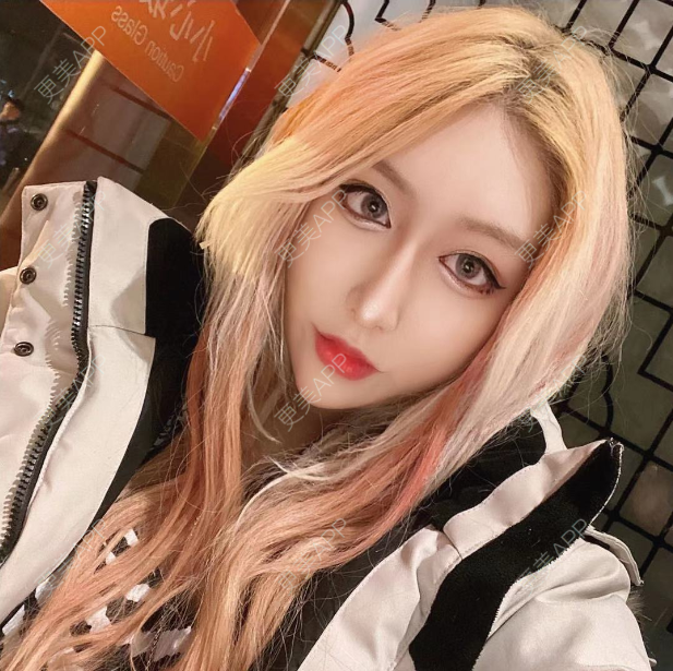 更美 - 更美用户KIeTphRcct的经验 | 自体脂肪面部填充 | 北京 | 自体脂肪丰苹果肌 | 自体脂肪丰太阳穴