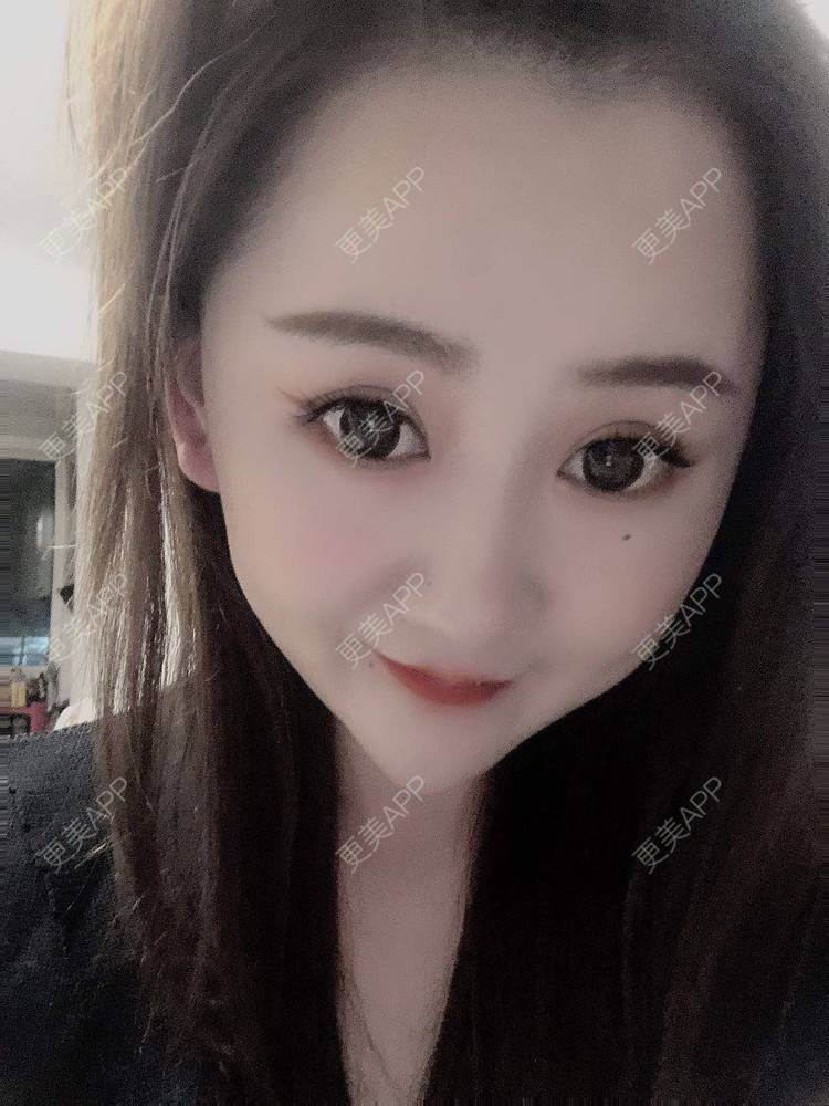 更美 - 更美用户8TTaEUIiwC的双眼皮经验 | 太阳穴 | 硅胶丰太阳穴 | 膨体丰太阳穴 | 全切双眼皮 | 双眼皮 | 自体脂肪丰太阳穴 | 武汉 | 拉皮 | 眼部多项 | 小切口手术提升