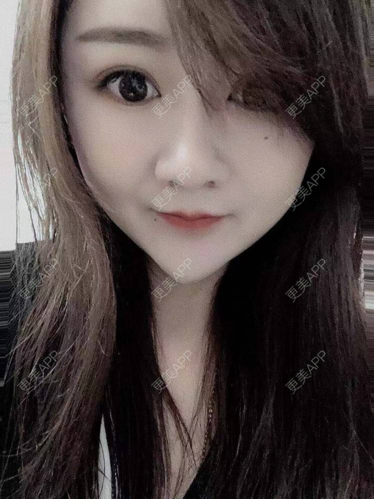 更美 - 更美用户8TTaEUIiwC的双眼皮经验 | 硅胶丰太阳穴 | 太阳穴 | 膨体丰太阳穴 | 全切双眼皮 | 双眼皮 | 自体脂肪丰太阳穴 | 武汉 | 拉皮 | 眼部多项 | 小切口手术提升