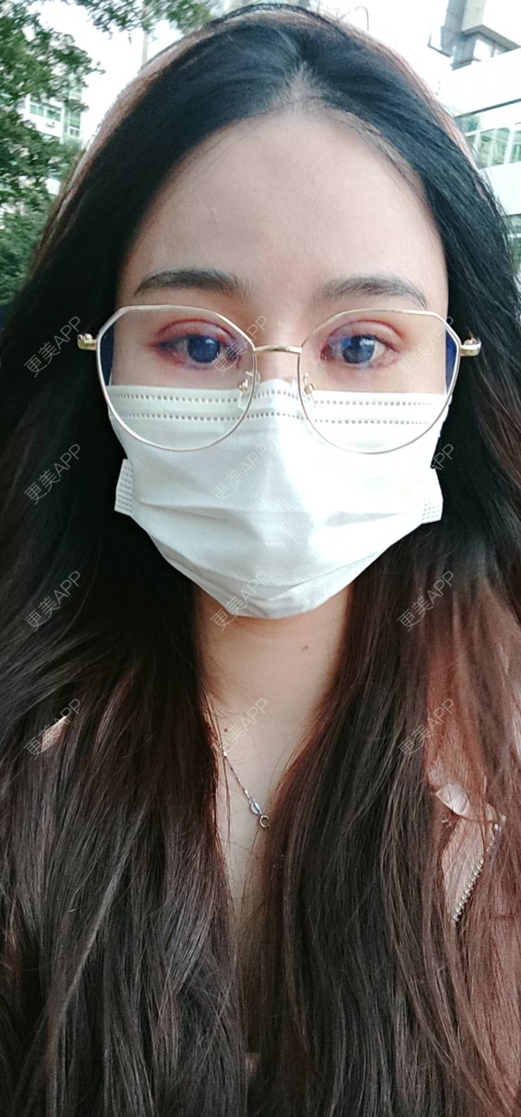 更美 - 欣欣的全切双眼皮经验 | 全切双眼皮 | 开内眼角 | 开外眼角 | 东莞 | 眼睑下至 | 眼部多项