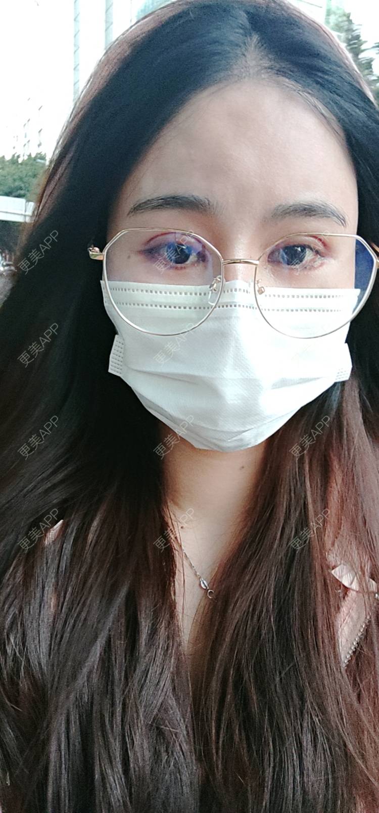 更美 - 欣欣的全切双眼皮经验 | 全切双眼皮 | 开内眼角 | 开外眼角 | 东莞 | 眼睑下至 | 眼部多项
