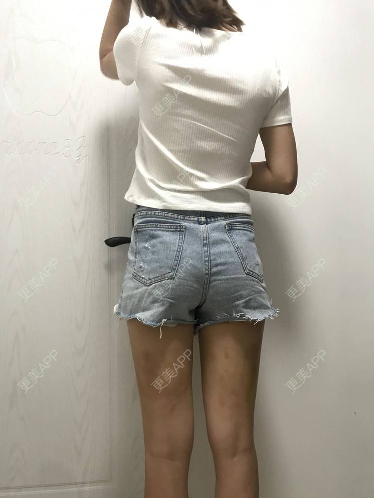 那遗矢dé圊舂鸵ゞ的吸脂瘦大腿日记