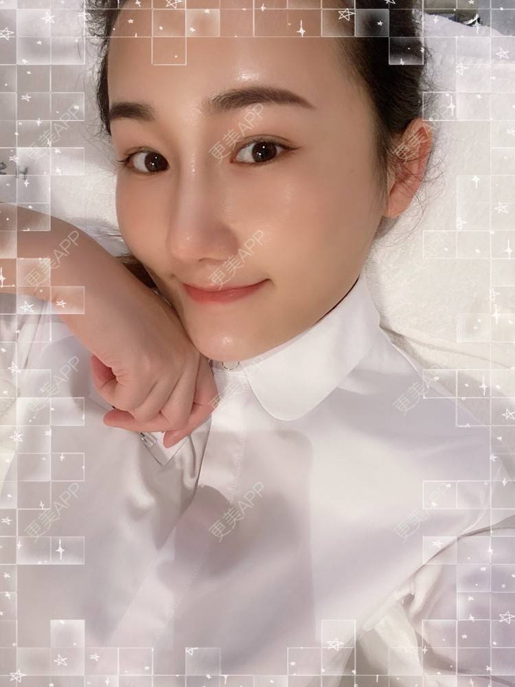 更美 - Yancy🧚‍♀️的隆鼻经验 | 隆鼻 | 鼻部多项 | 膨体隆鼻 | 肋软骨隆鼻 | 鼻翼缩小 | 深圳 | 长鼻矫正 | 视频日记