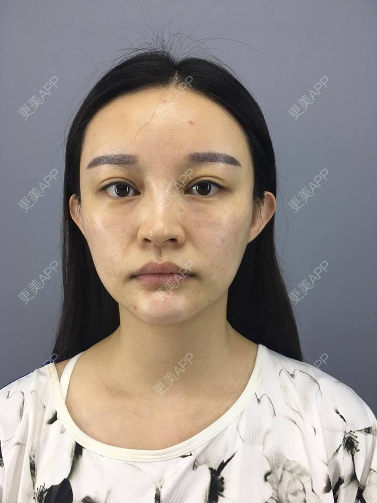 更美 - Face溜溜的经验 | 自体脂肪面部填充 | 视频日记 | 重庆