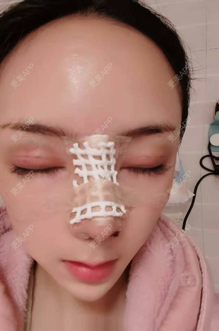 更美 - 更美用户RUDkRBxIQc的鼻部多项经验 | 鼻中隔软骨隆鼻 | 肋软骨隆鼻 | 鼻翼缩小 | 鼻小柱延长 | 鼻部多项