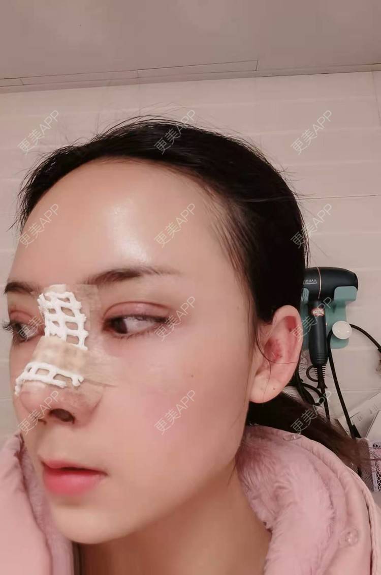 更美 - 更美用户RUDkRBxIQc的鼻部多项经验 | 鼻中隔软骨隆鼻 | 肋软骨隆鼻 | 鼻翼缩小 | 鼻小柱延长 | 鼻部多项
