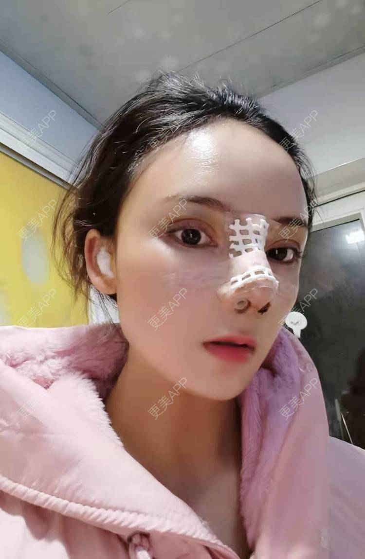 更美 - 更美用户RUDkRBxIQc的鼻部多项经验 | 鼻中隔软骨隆鼻 | 肋软骨隆鼻 | 鼻翼缩小 | 鼻小柱延长 | 鼻部多项