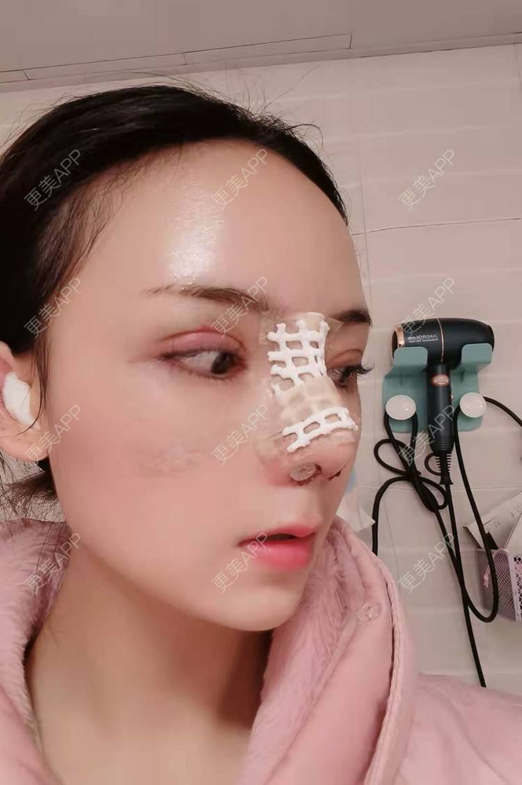 更美 - 更美用户RUDkRBxIQc的鼻部多项经验 | 鼻中隔软骨隆鼻 | 肋软骨隆鼻 | 鼻翼缩小 | 鼻小柱延长 | 鼻部多项