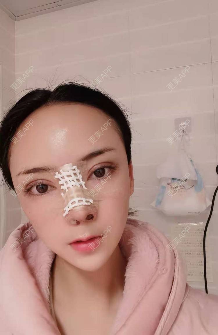 更美 - 更美用户RUDkRBxIQc的鼻部多项经验 | 鼻中隔软骨隆鼻 | 肋软骨隆鼻 | 鼻翼缩小 | 鼻小柱延长 | 鼻部多项