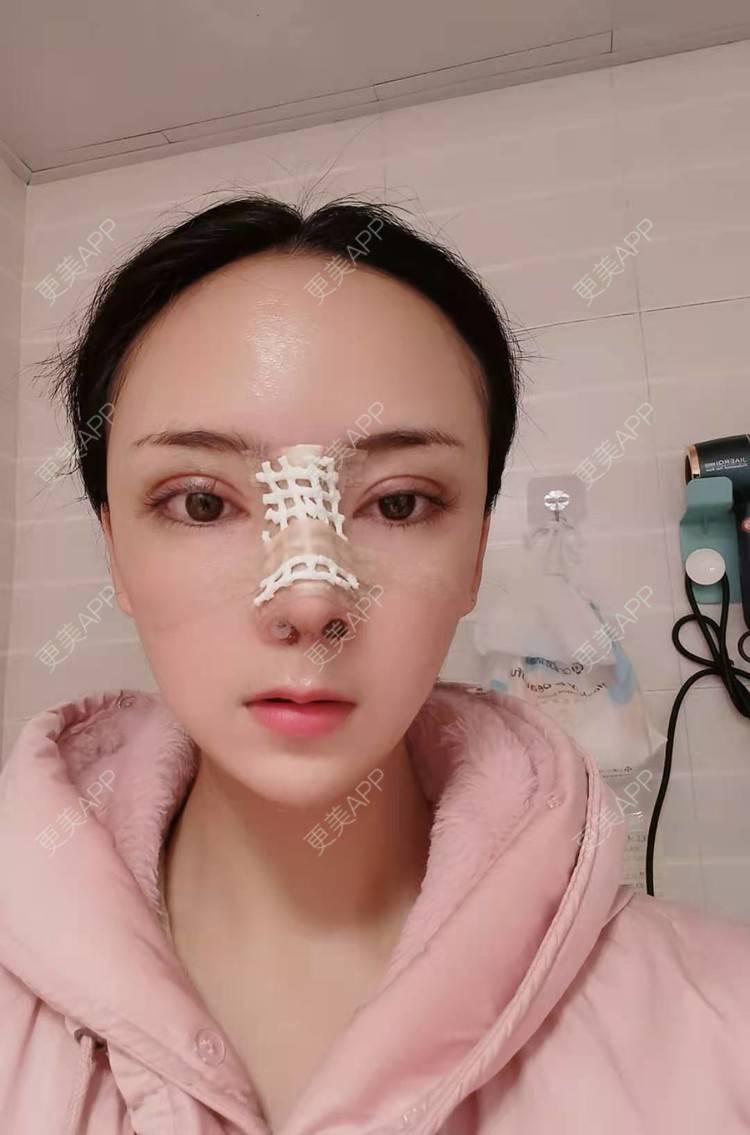 更美 - 更美用户RUDkRBxIQc的鼻部多项经验 | 鼻中隔软骨隆鼻 | 肋软骨隆鼻 | 鼻翼缩小 | 鼻小柱延长 | 鼻部多项