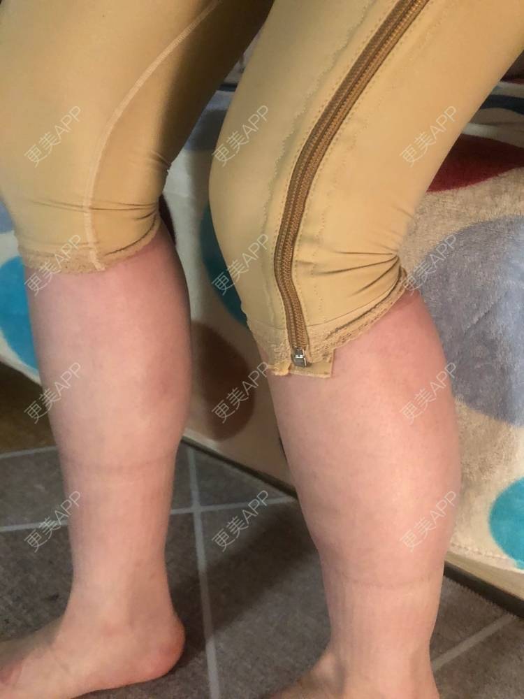 更美 - 岸芷1的吸脂经验 | 武汉 | 吸脂