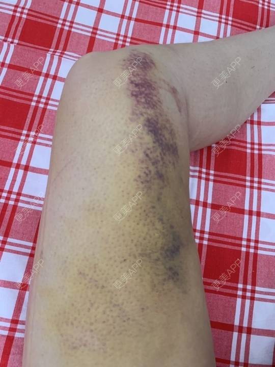 更美 - 海棠才谢擞的吸脂经验 | 武汉 | 吸脂