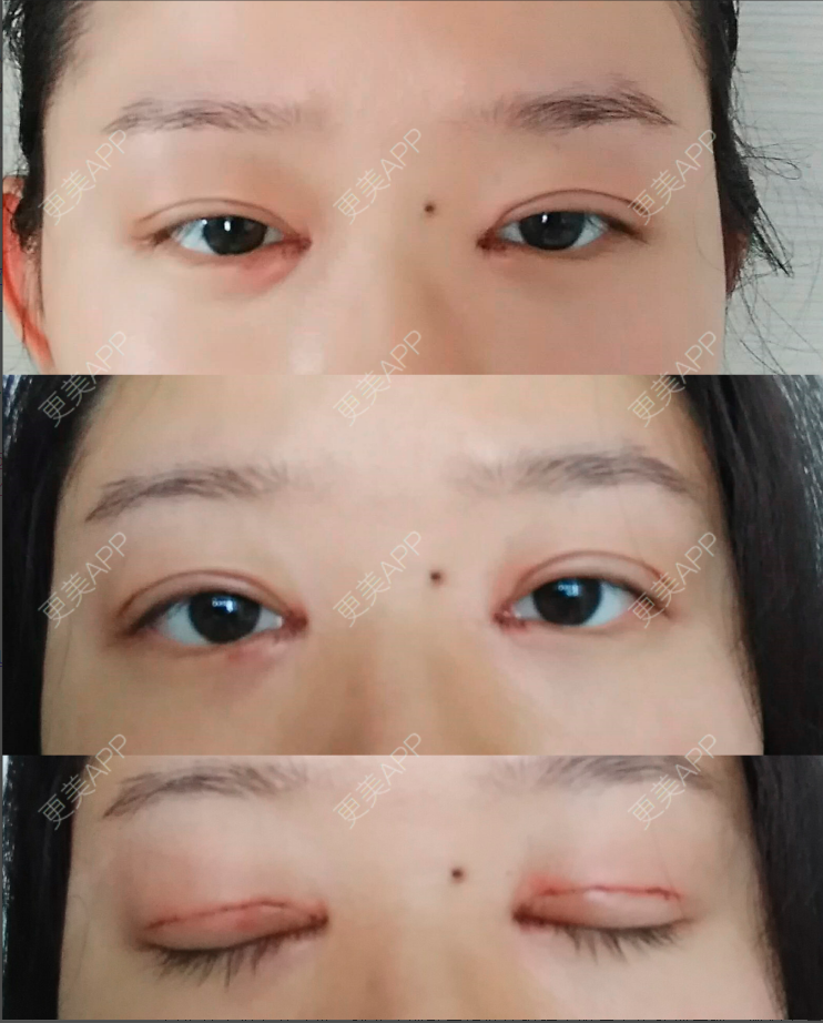 更美 - 更美用户XidFn5zMWm的全切双眼皮经验 | 眼部多项 | 全切双眼皮 | 成都