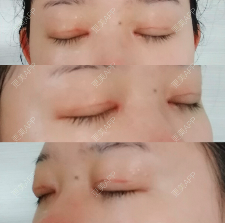 更美 - 更美用户XidFn5zMWm的全切双眼皮经验 | 眼部多项 | 全切双眼皮 | 成都