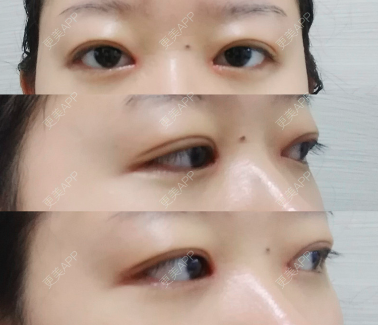 更美 - 更美用户XidFn5zMWm的全切双眼皮经验 | 眼部多项 | 全切双眼皮 | 成都