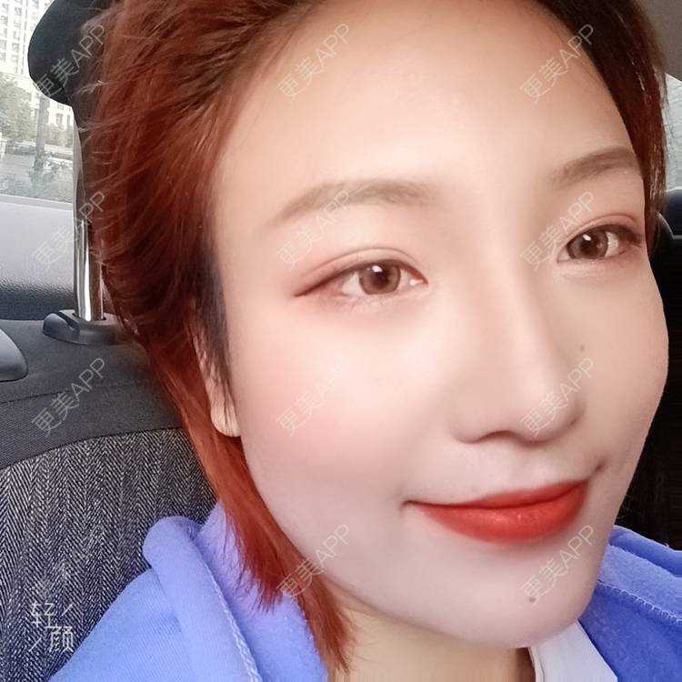 更美 - 更美用户tbs28rKiLZ的定点双眼皮经验 | 定点双眼皮 | 杭州