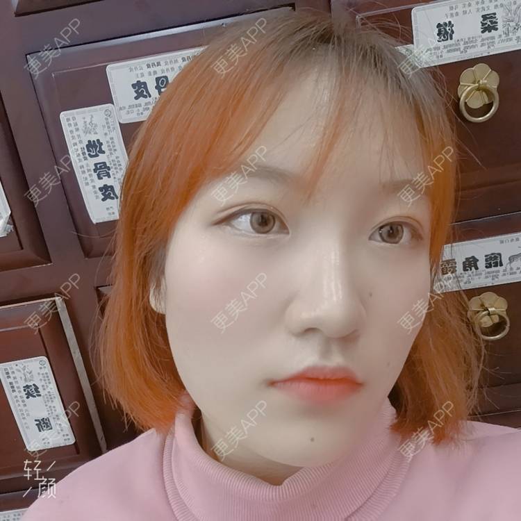 更美 - 更美用户tbs28rKiLZ的定点双眼皮经验 | 定点双眼皮 | 杭州