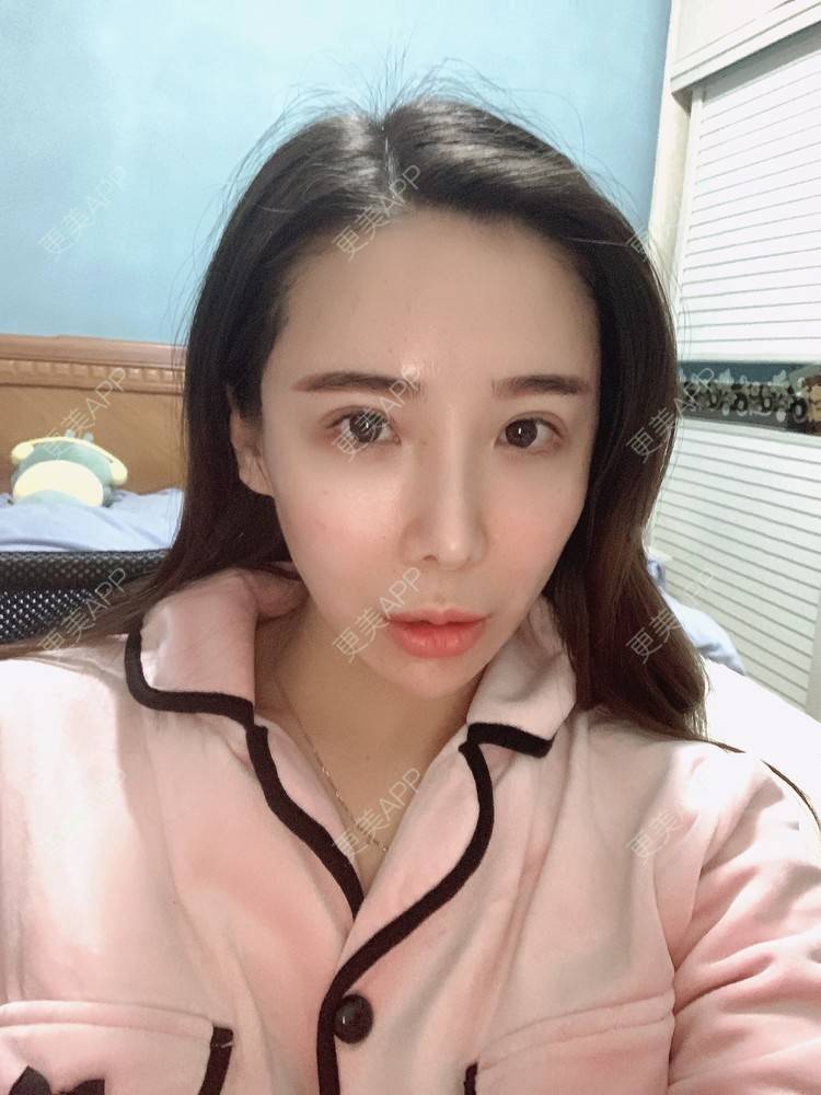 更美 - 于菲的胶原蛋白淡化黑眼圈经验 | 胶原蛋白淡化黑眼圈 | 杭州