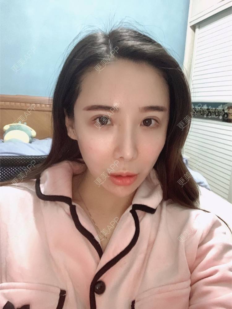 更美 - 于菲的胶原蛋白淡化黑眼圈经验 | 杭州 | 胶原蛋白淡化黑眼圈