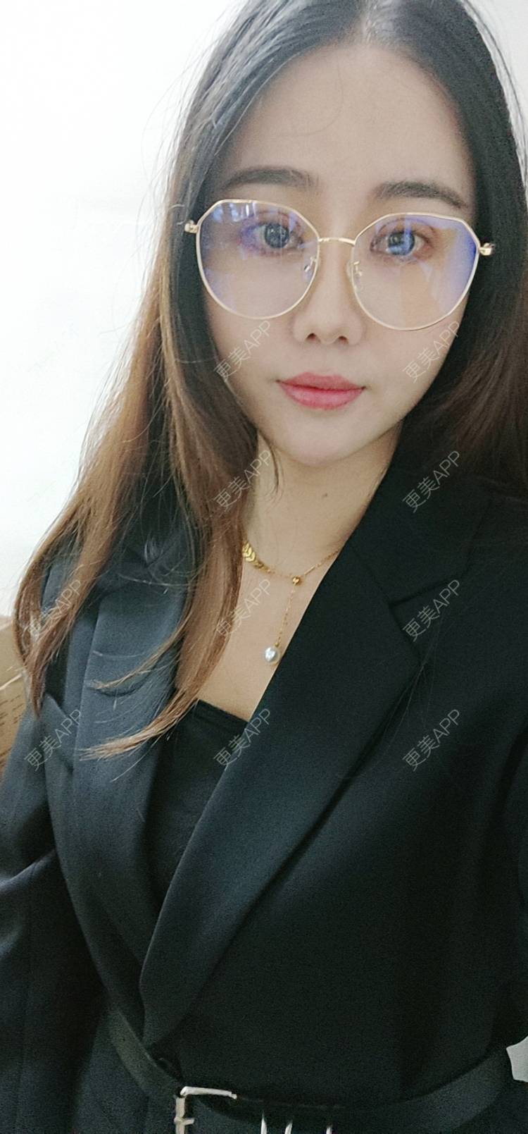 更美 - 欣欣的全切双眼皮经验 | 全切双眼皮 | 开内眼角 | 开外眼角 | 东莞 | 眼睑下至 | 眼部多项