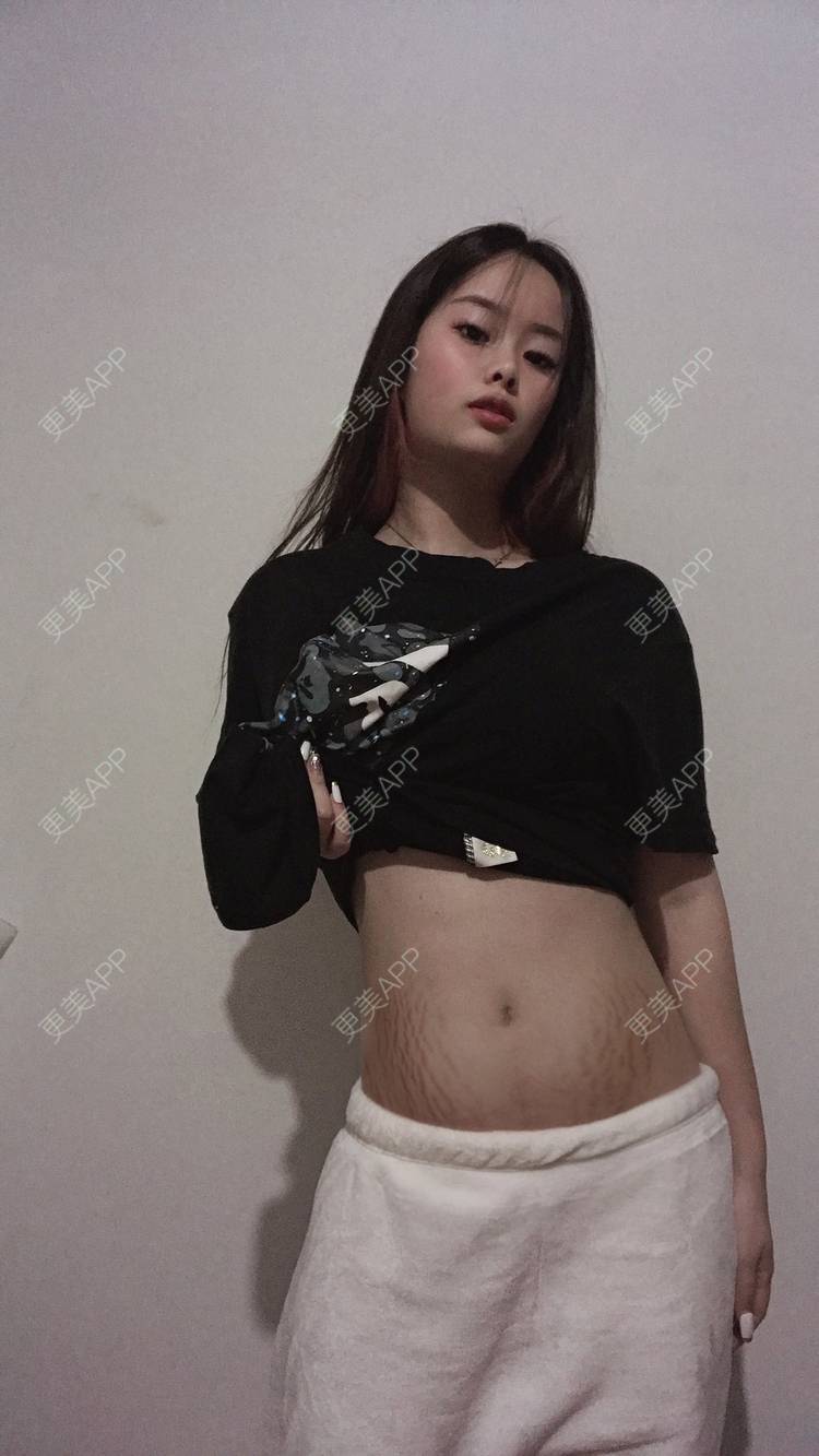 更美 - 把难过说给风仲的激光淡化妊娠纹经验 | 皮肤美容 | 皮肤检测 | 激光淡化妊娠纹 | 成都