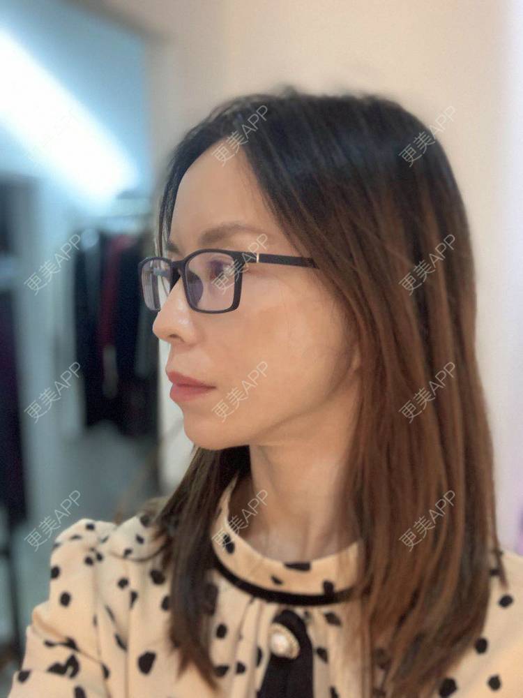 更美 - 更美用户m5TLM1rzA5的拉皮经验 | 拉皮 | 北京