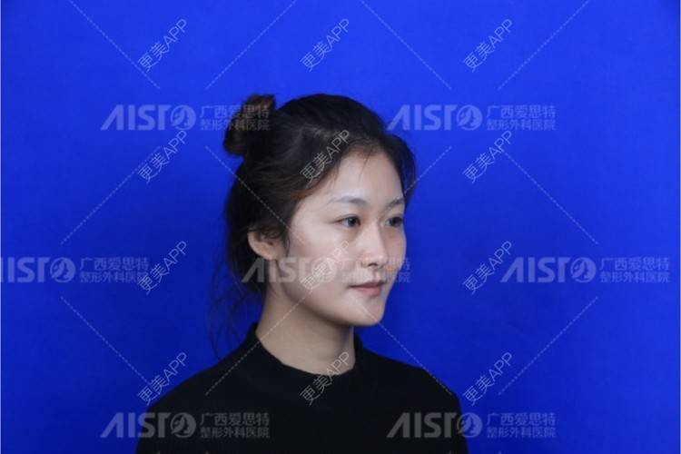 更美 - 更美用户wd21LfJJRv的上下颚手术经验 | 南宁 | 上下颚手术