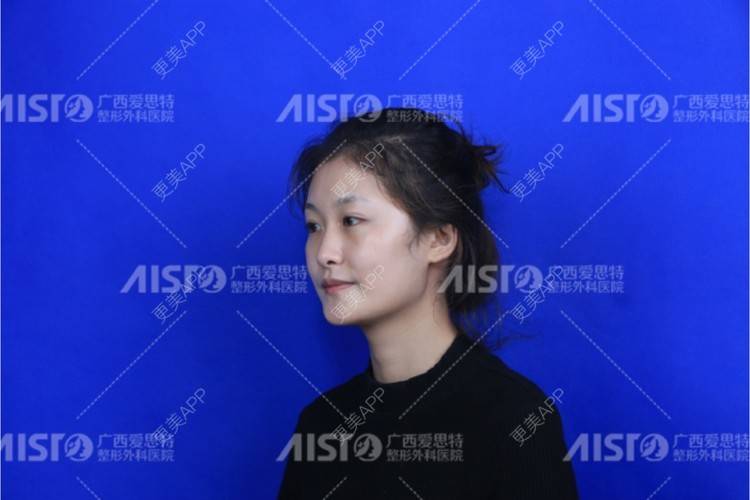 更美 - 更美用户wd21LfJJRv的上下颚手术经验 | 南宁 | 上下颚手术