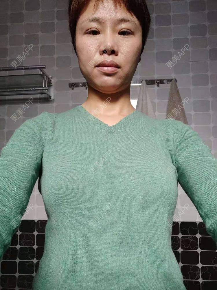 更美 - 更美用户gZFN64zuwo的丰胸（隆胸）经验 | 自体脂肪隆胸 | 乳房再造 | 胸部下垂矫正 | 美胸套餐 | 手术去副乳 | 丰胸（隆胸） | 假体隆胸 | 乳头内陷矫正 | 重庆 | 胶原蛋白丰胸 | 复合隆胸