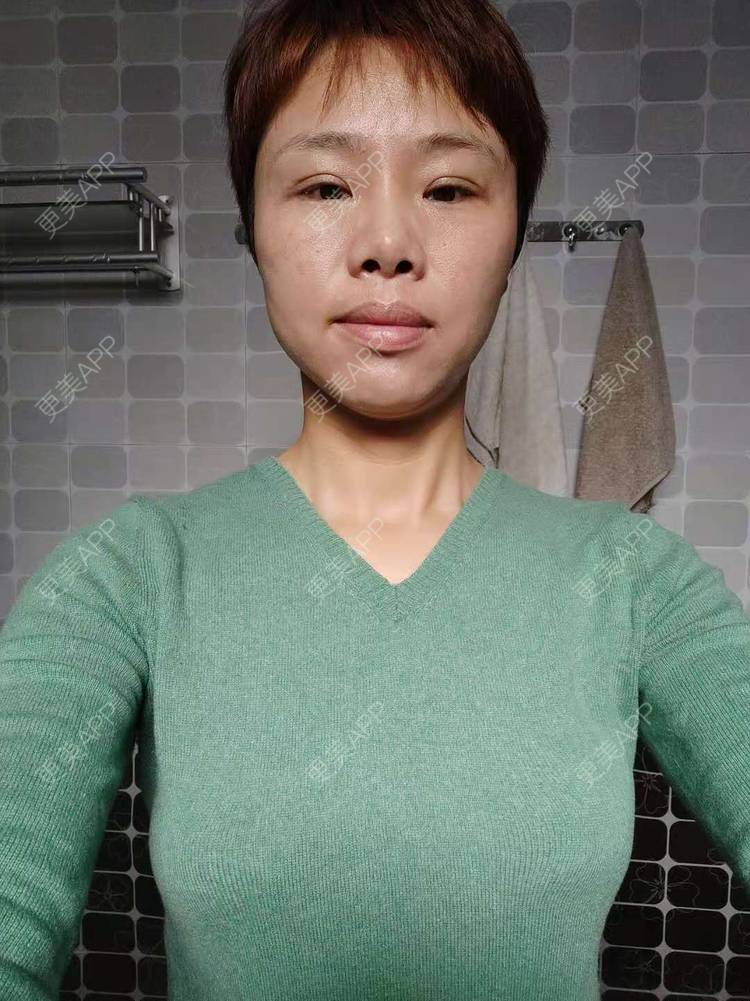 更美 - 更美用户gZFN64zuwo的丰胸（隆胸）经验 | 自体脂肪隆胸 | 乳房再造 | 胸部下垂矫正 | 美胸套餐 | 手术去副乳 | 丰胸（隆胸） | 假体隆胸 | 乳头内陷矫正 | 重庆 | 胶原蛋白丰胸 | 复合隆胸