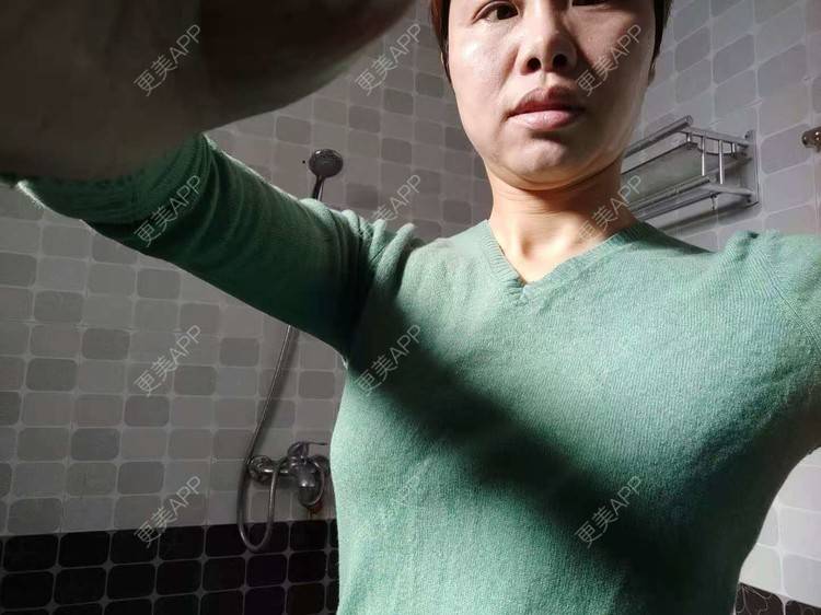 更美 - 更美用户gZFN64zuwo的丰胸（隆胸）经验 | 自体脂肪隆胸 | 乳房再造 | 胸部下垂矫正 | 美胸套餐 | 手术去副乳 | 丰胸（隆胸） | 假体隆胸 | 乳头内陷矫正 | 重庆 | 胶原蛋白丰胸 | 复合隆胸