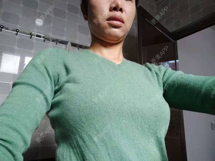 更美 - 更美用户gZFN64zuwo的丰胸（隆胸）经验 | 自体脂肪隆胸 | 乳房再造 | 胸部下垂矫正 | 美胸套餐 | 手术去副乳 | 丰胸（隆胸） | 假体隆胸 | 乳头内陷矫正 | 重庆 | 胶原蛋白丰胸 | 复合隆胸