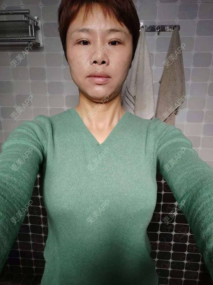 更美 - 更美用户gZFN64zuwo的丰胸（隆胸）经验 | 自体脂肪隆胸 | 乳房再造 | 胸部下垂矫正 | 美胸套餐 | 手术去副乳 | 丰胸（隆胸） | 假体隆胸 | 乳头内陷矫正 | 重庆 | 胶原蛋白丰胸 | 复合隆胸