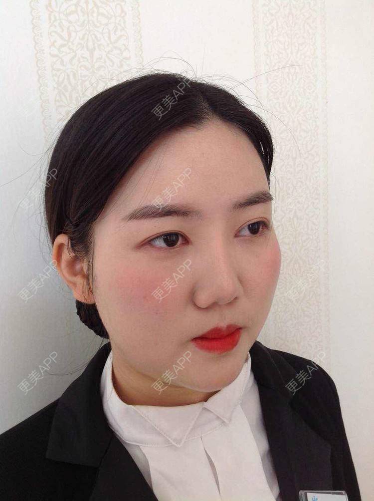 更美 - 陶三岁的硅胶垫下巴经验 | 硅胶垫下巴 | 襄阳