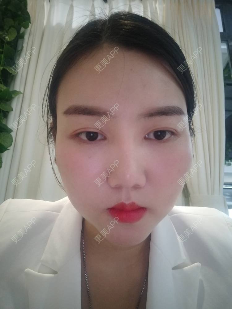更美 - 陶三岁的硅胶垫下巴经验 | 硅胶垫下巴 | 襄阳