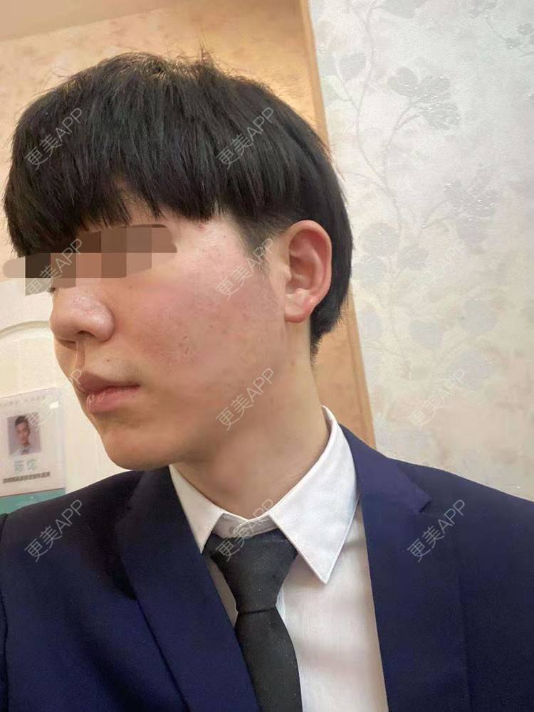 更美 - 男神你去那里呀嘎的PRP自体血清美肤经验 | PRP自体血清美肤 | 北京