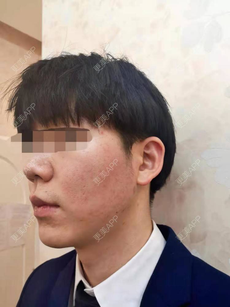 更美 - 男神你去那里呀嘎的PRP自体血清美肤经验 | PRP自体血清美肤 | 北京