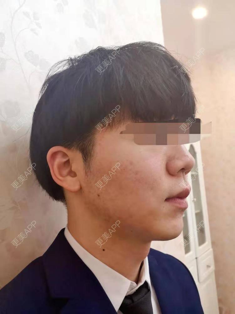 更美 - 男神你去那里呀嘎的PRP自体血清美肤经验 | PRP自体血清美肤 | 北京