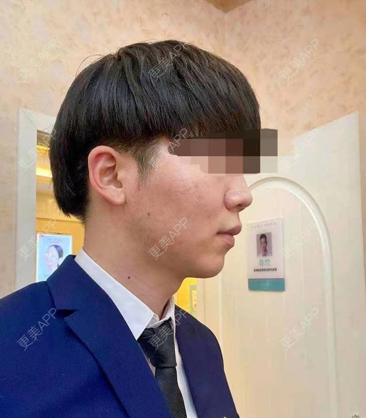 更美 - 男神你去那里呀嘎的PRP自体血清美肤经验 | PRP自体血清美肤 | 北京