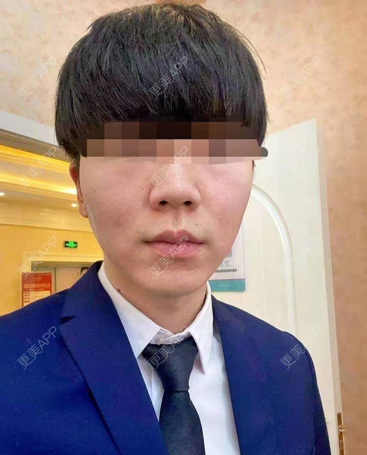 更美 - 男神你去那里呀嘎的PRP自体血清美肤经验 | PRP自体血清美肤 | 北京
