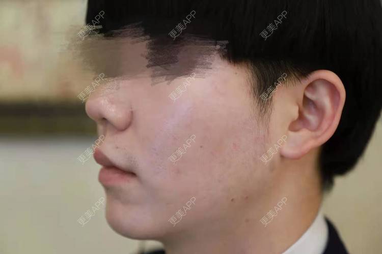更美 - 男神你去那里呀嘎的PRP自体血清美肤经验 | PRP自体血清美肤 | 北京