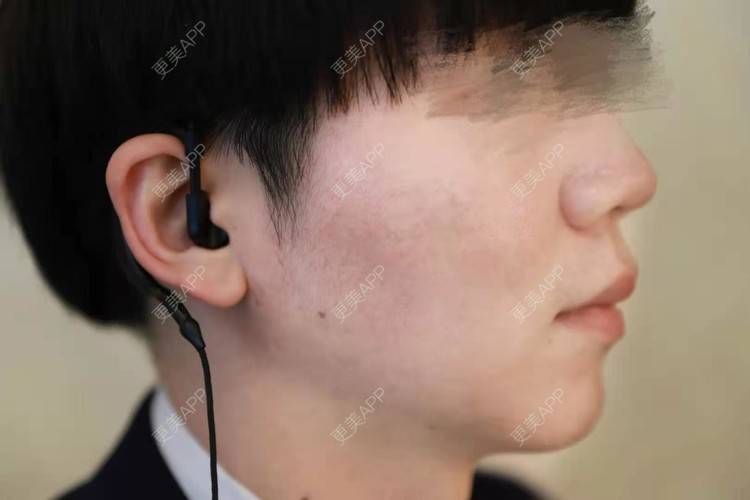 更美 - 男神你去那里呀嘎的PRP自体血清美肤经验 | PRP自体血清美肤 | 北京