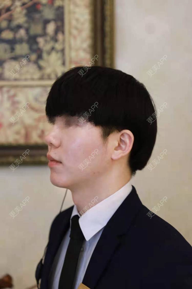 更美 - 男神你去那里呀嘎的PRP自体血清美肤经验 | PRP自体血清美肤 | 北京