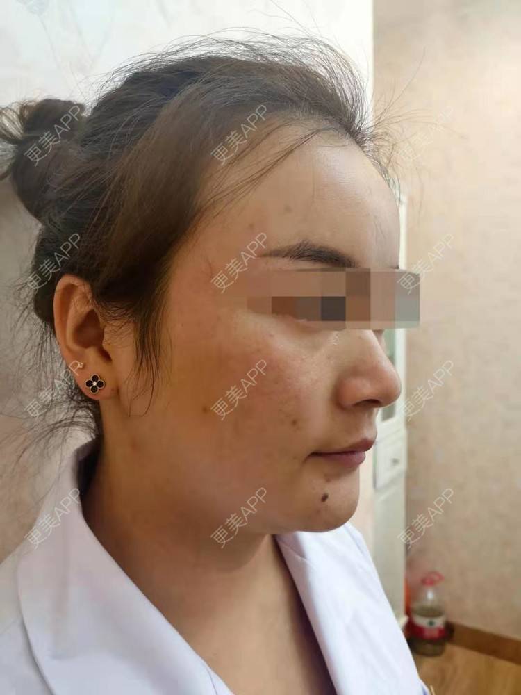 更美 - 笑忘罢衣的PRP自体血清美肤经验 | PRP自体血清美肤