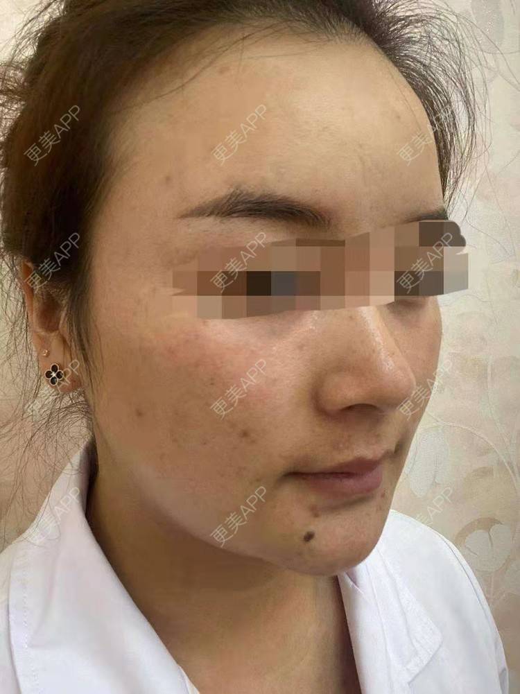 更美 - 笑忘罢衣的PRP自体血清美肤经验 | PRP自体血清美肤