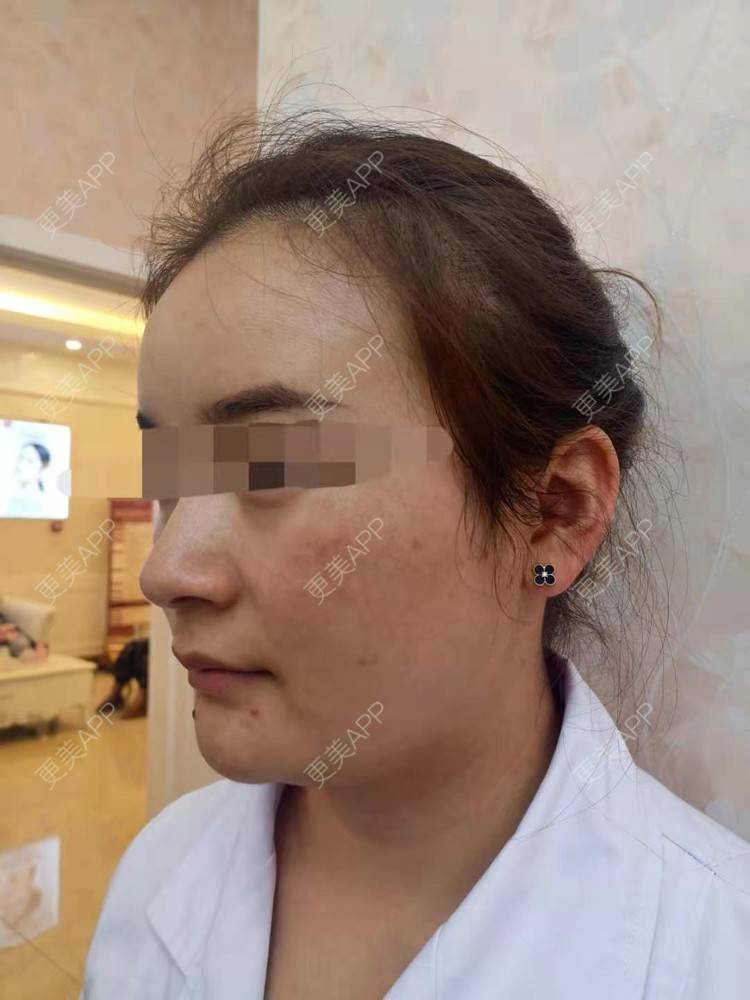 更美 - 笑忘罢衣的PRP自体血清美肤经验 | PRP自体血清美肤