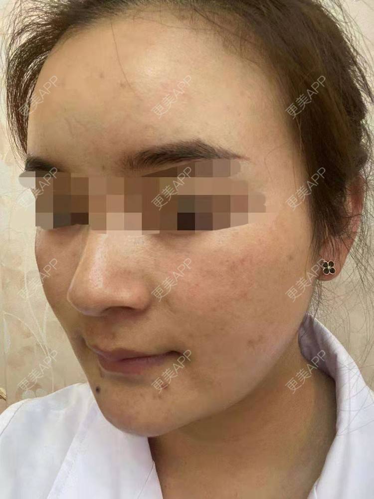 更美 - 笑忘罢衣的PRP自体血清美肤经验 | PRP自体血清美肤